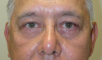 Blepharoplasty