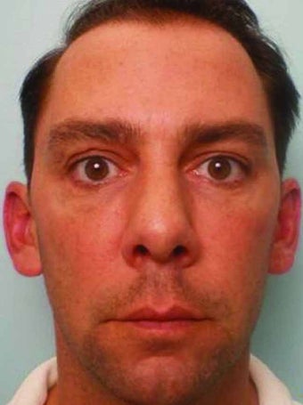 BOTOX combined with Juvederm Injections