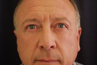 Blepharaoplasty
