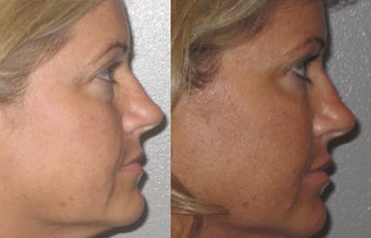 Non-surgical liquid eyelid lift