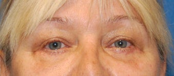 Lower Blephoplasty