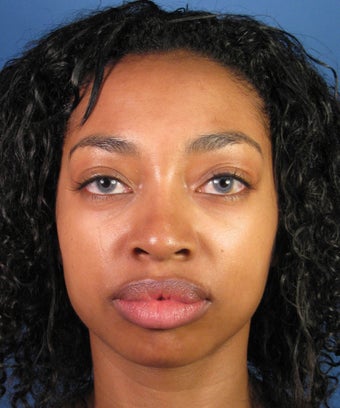 Eyelid Lift Blepharoplasty