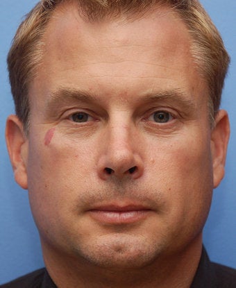 Cheek Dermafiller, Under Eye Dermafiller