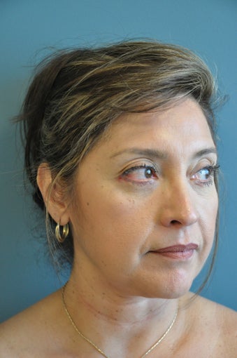 Lower Blepharoplasty