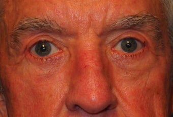 Extended lower lid blepharoplasty