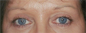 Endoscopic Browlift and Upper & Lower Blepharoplasty