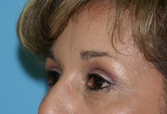 Lower Blepharoplasty