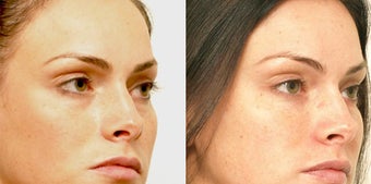 Non Surgical Liquid Eyelid Lift