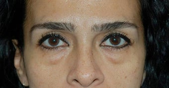 Lower lid blepharoplasty and Fat Transfer to lower lids and midface