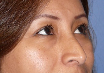 Transconjuctival lower eyelids.  No scar!