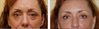 Blepharoplasty
