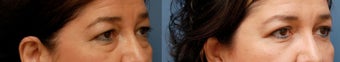 Lower Blepharoplasty