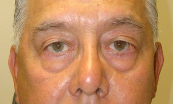 Blepharoplasty