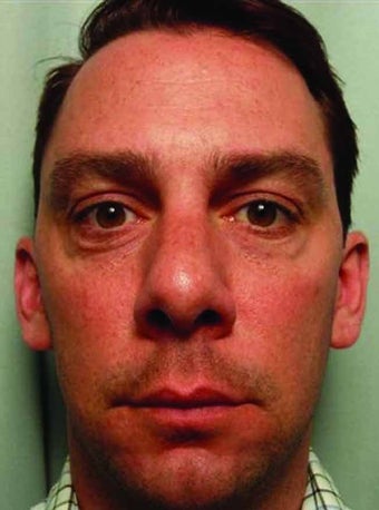 BOTOX combined with Juvederm Injections