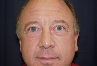 Blepharaoplasty