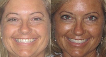 Non-surgical liquid eyelid lift