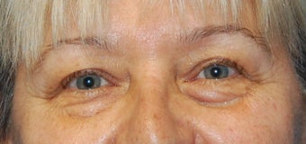 Lower Blephoplasty