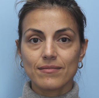 Eye Dermafillers,Cheek Dermafillers,Facial Dermafillers