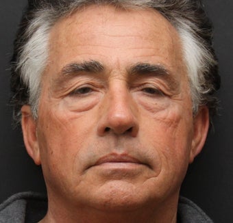 Upper and Lower Belpharoplasty