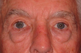 Extended lower lid blepharoplasty