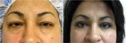 Blepharoplasty