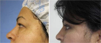 Blepharoplasty