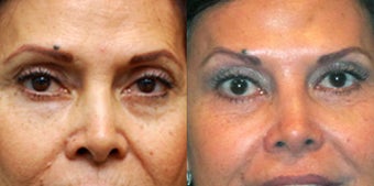 Non Surgical Liquid Eyelid Lift 