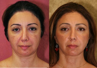 Eyelid surgery or blepharoplasty