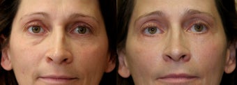 Eyelid surgery or blepharoplasty