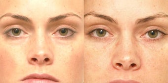 Non Surgical Liquid Eyelid Lift