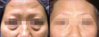 Lower Eyelid(Blepharoplasty) Surgery