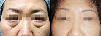 Lower Eyelid(Blepharoplasty) Surgery 