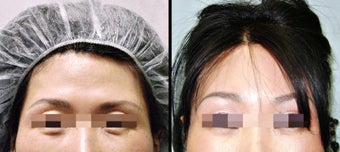 Lower Eyelid(Blepharoplasty) Surgery