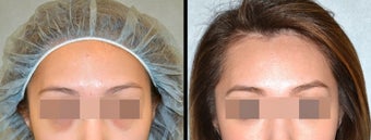 Lower Eyelid(Blepharoplasty) Surgery