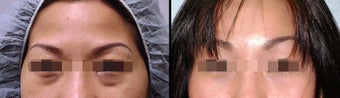 Lower Eyelid(Blepharoplasty) Surgery