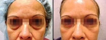 Lower Eyelid(Blepharoplasty) Surgery
