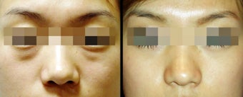 Lower Eyelid(Blepharoplasty) Surgery