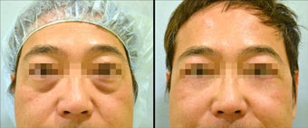 Lower Eyelid(Blepharoplasty) Surgery