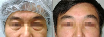 Lower Eyelid(Blepharoplasty) Surgery
