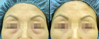 Lower Eyelid(Blepharoplasty) Surgery