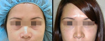 Lower Eyelid(Blepharoplasty) Surgery