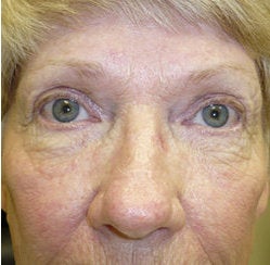Cosmetic eyelid surgery