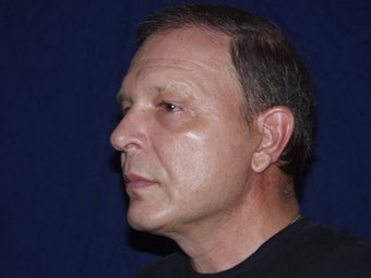 Before and after blepharoplasty