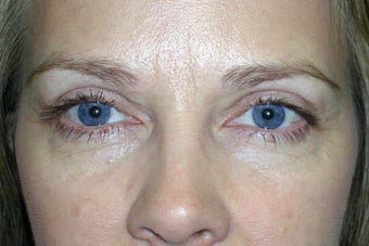 Ptosis Repair and Blepharoplasty