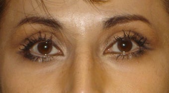 Upper Lid ptosis repair