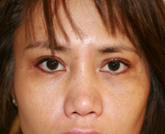 Upper eyelid blepharoplasty