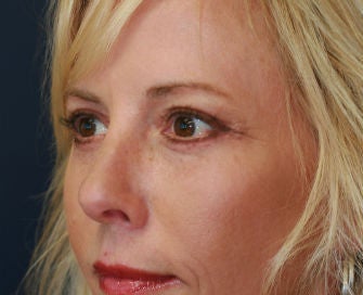 Upper and Lower Eyelids
