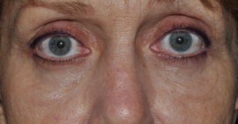 Bilateral upper and lower blepharoplasty, and 4 lid permanent eyeliner