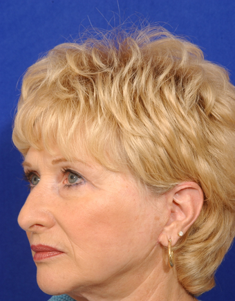 Upper blepharoplsty with cheeklift, facelift 