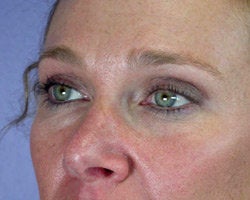 Eyelid Surgery